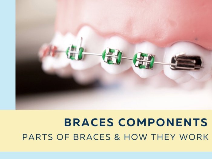 Braces diagram bands orthodontics